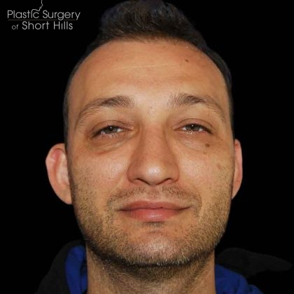 Rhinoplasty Before & After Patient #16564