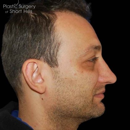 Rhinoplasty Before & After Patient #16564