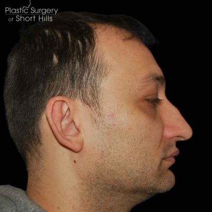 Rhinoplasty Before & After Patient #16564