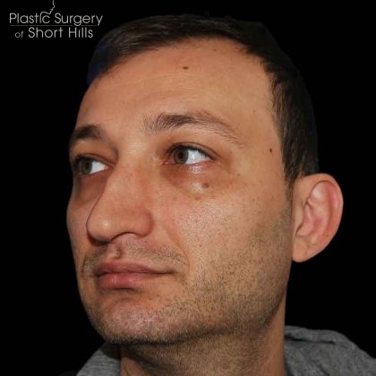 Rhinoplasty Before & After Patient #16564