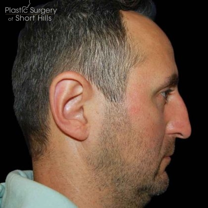Rhinoplasty Before & After Patient #16565