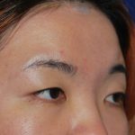 Blepharoplasty Before & After Patient #16407