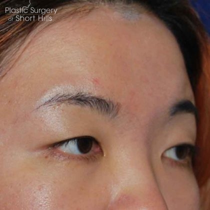 Blepharoplasty Before & After Patient #16407