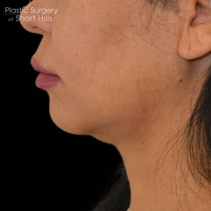 Liposuction-Face Before & After Patient #16415