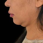 Liposuction-Face Before & After Patient #16415
