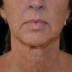 Liposuction-Face Before & After Patient #16353