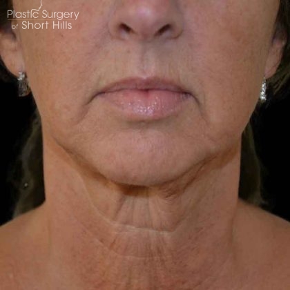 Liposuction-Face Before & After Patient #16353