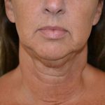 Liposuction-Face Before & After Patient #16353