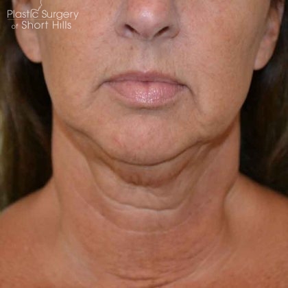 Liposuction-Face Before & After Patient #16353