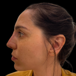 Liquid Rhinoplasty(Non-Surgical) Before & After Patient #16374