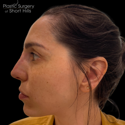 Liquid Rhinoplasty(Non-Surgical) Before & After Patient #16374