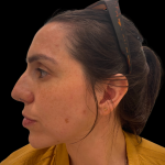 Liquid Rhinoplasty(Non-Surgical) Before & After Patient #16374