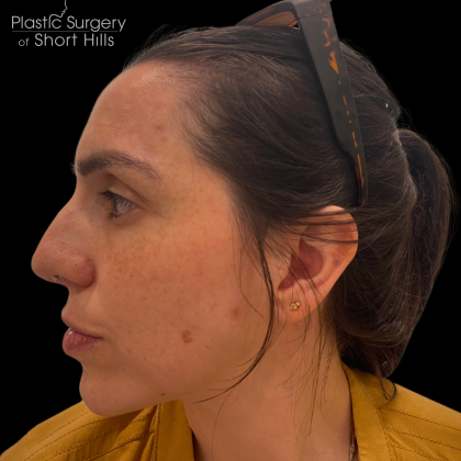 Liquid Rhinoplasty(Non-Surgical) Before & After Patient #16374