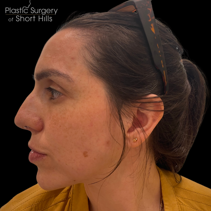 Liquid Rhinoplasty(Non-Surgical) Before & After Patient #16374