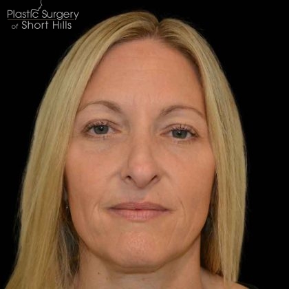 Revision Rhinoplasty Before & After Patient #16497