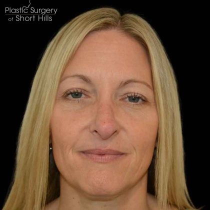 Revision Rhinoplasty Before & After Patient #16497