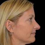 Revision Rhinoplasty Before & After Patient #16497