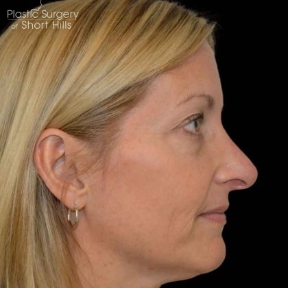 Revision Rhinoplasty Before & After Patient #16497