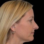 Revision Rhinoplasty Before & After Patient #16497