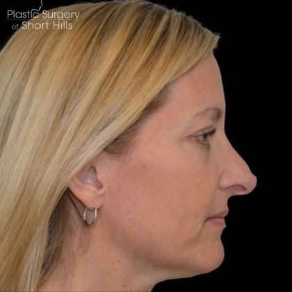Revision Rhinoplasty Before & After Patient #16497