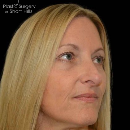 Revision Rhinoplasty Before & After Patient #16497