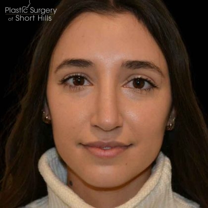 Revision Rhinoplasty Before & After Patient #16576