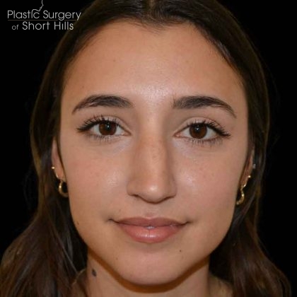 Revision Rhinoplasty Before & After Patient #16576