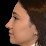 Revision Rhinoplasty Before & After Patient #16576