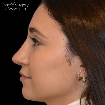 Revision Rhinoplasty Before & After Patient #16576