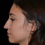 Revision Rhinoplasty Before & After Patient #16576