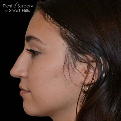 Revision Rhinoplasty Before & After Patient #16576