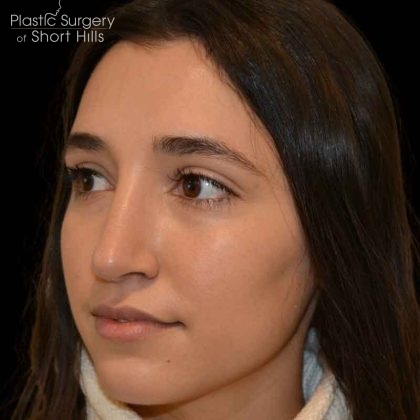 Revision Rhinoplasty Before & After Patient #16576