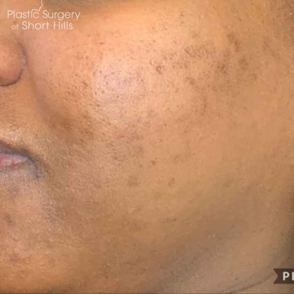 Chemical Peel Before & After Patient #16408