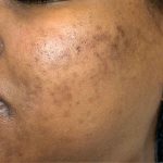 Chemical Peel Before & After Patient #16408