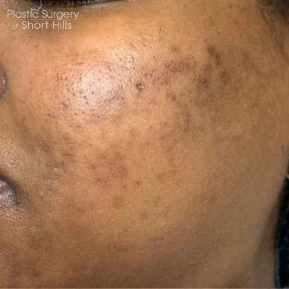 Chemical Peel Before & After Patient #16408