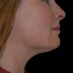 Liposuction-Face Before & After Patient #16418