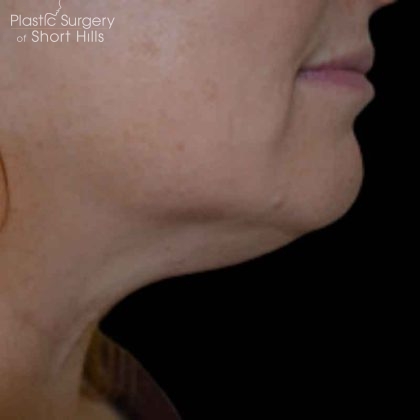 Liposuction-Face Before & After Patient #16418