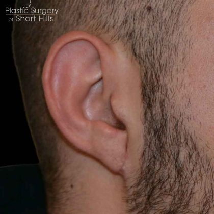 Earlobe Repair Before & After Patient #16568