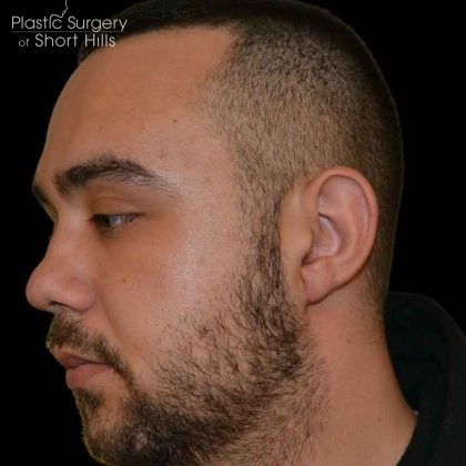 Earlobe Repair Before & After Patient #16568