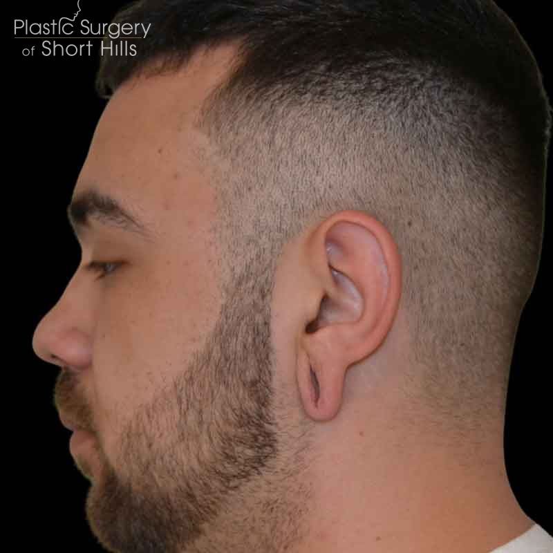 Earlobe Repair Before & After Patient #16568