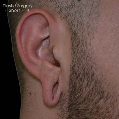 Earlobe Repair Before & After Patient #16568