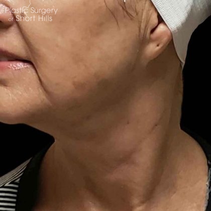 RF Microneedling Before & After Patient #16373