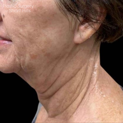 RF Microneedling Before & After Patient #16373