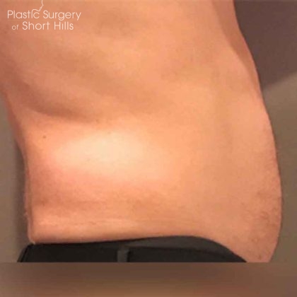 TruSculpt 3D Before & After Patient #16349