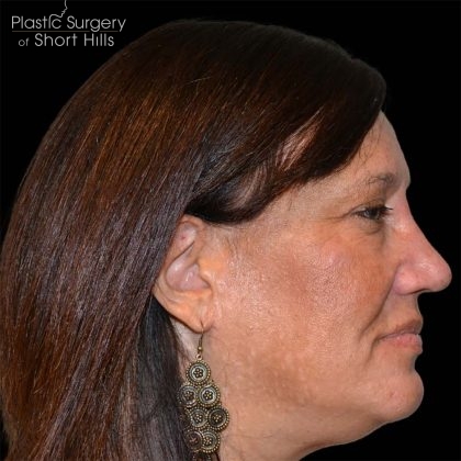 Rhinoplasty Before & After Patient #16717