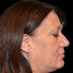 Rhinoplasty Before & After Patient #16717