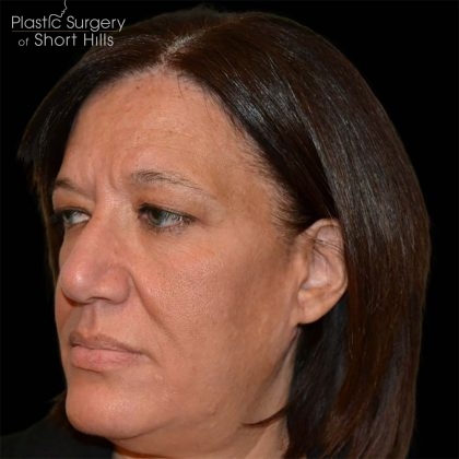 Rhinoplasty Before & After Patient #16717
