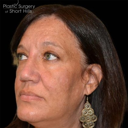 Rhinoplasty Before & After Patient #16717