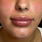 Lip Filler Before & After Patient #16751