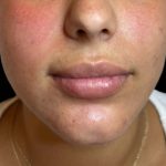 Lip Filler Before & After Patient #16751
